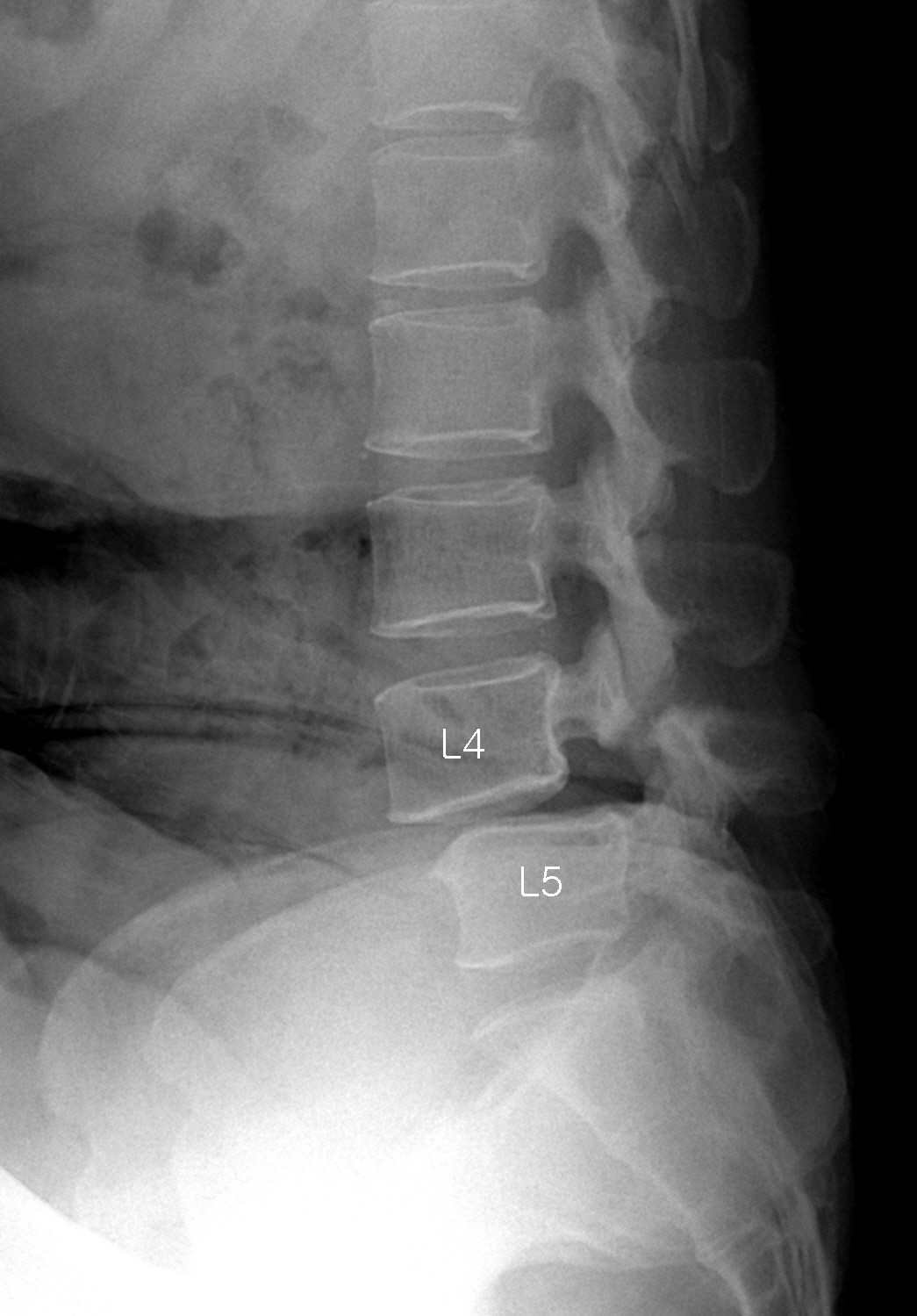 Listhesis